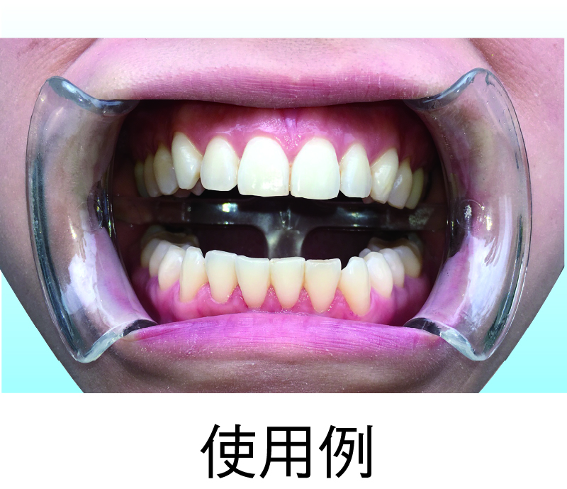 マウスオープナー 開口器 歯科用 リトラクター 青色